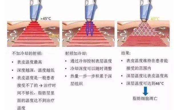 盐城射频溶脂减肥的优势是什么